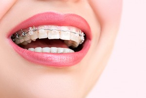 dental-braces